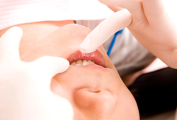 歯のクリーニング・PMTC（歯面清掃）